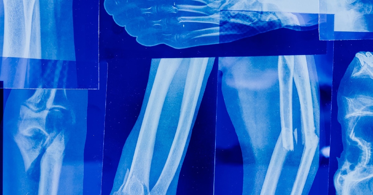 Osteoporosis – a silent burden
